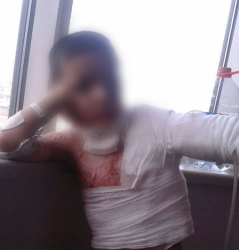 A child suffering from severe burns