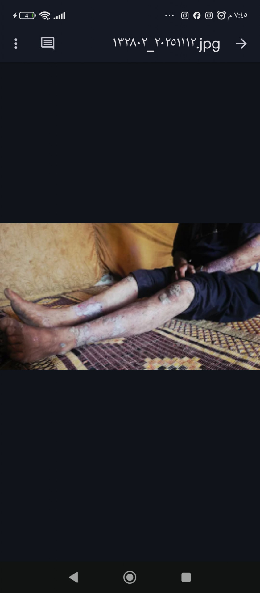 عبدالزراق يواجهُ الألم وحده