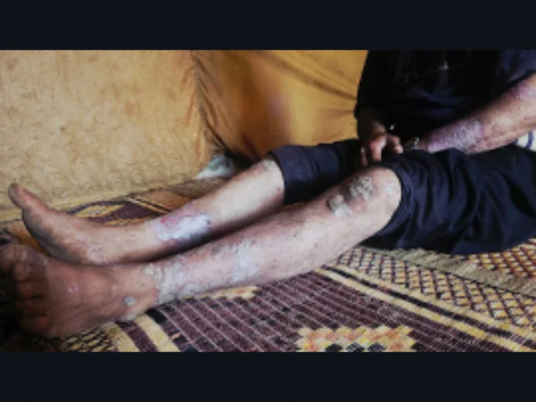 عبدالزراق يواجهُ الألم وحده