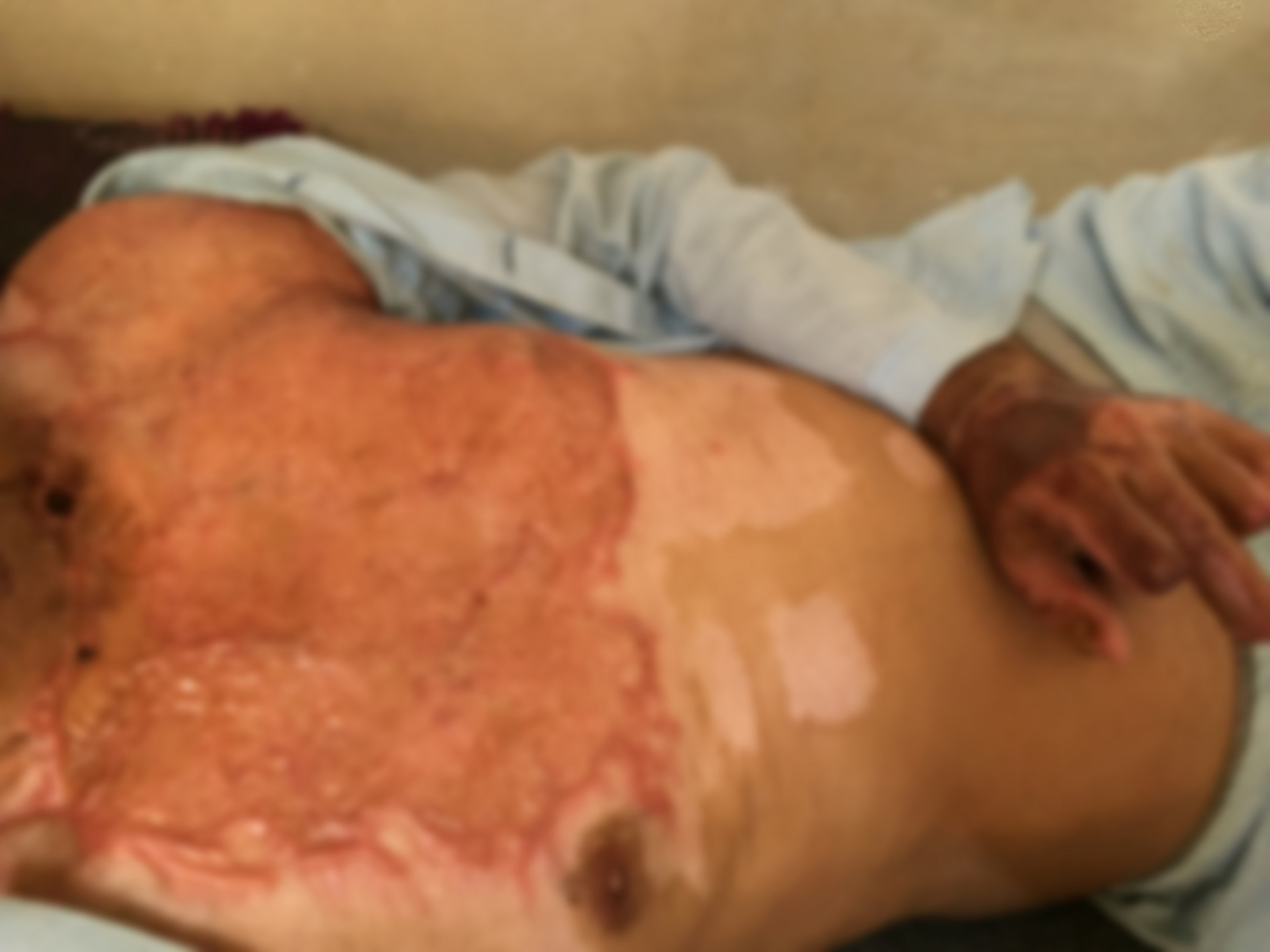 Hussein, had severe burns all over his body leaving his family without support
