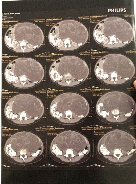 A child needs an abdomino-pelvic CT scan with contrast