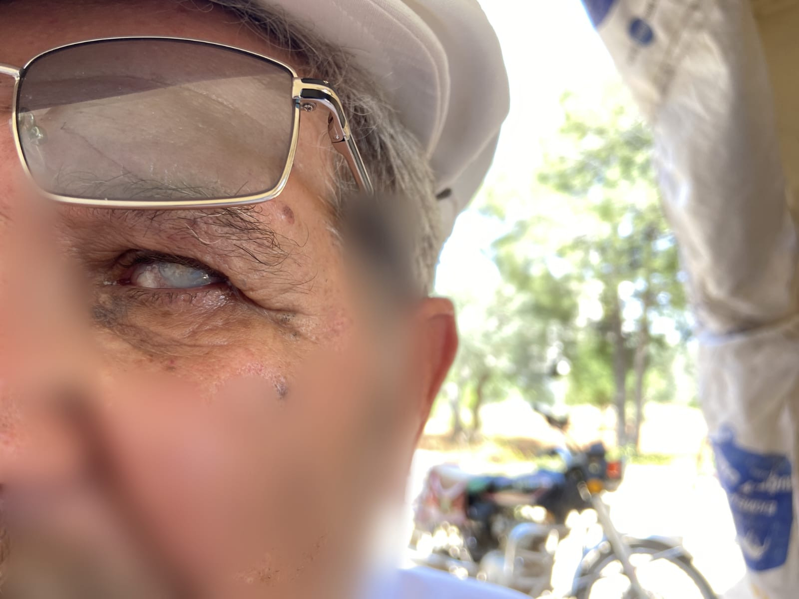 Naef may lose his vision.