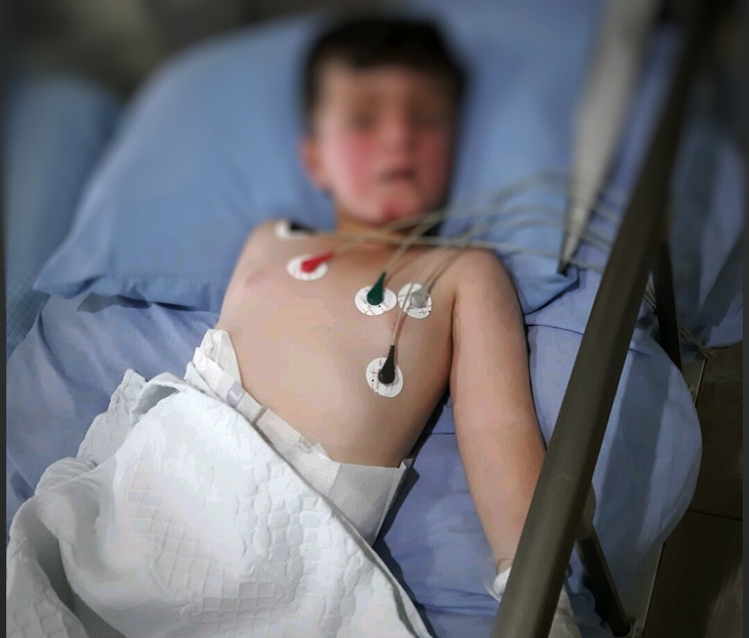 kid with right side paralysis