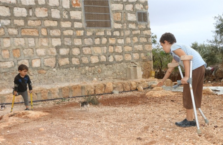 two brothers lost their legs due to bombardment