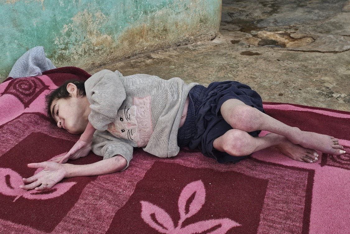 ضمور عقلي وحركي لطفلين