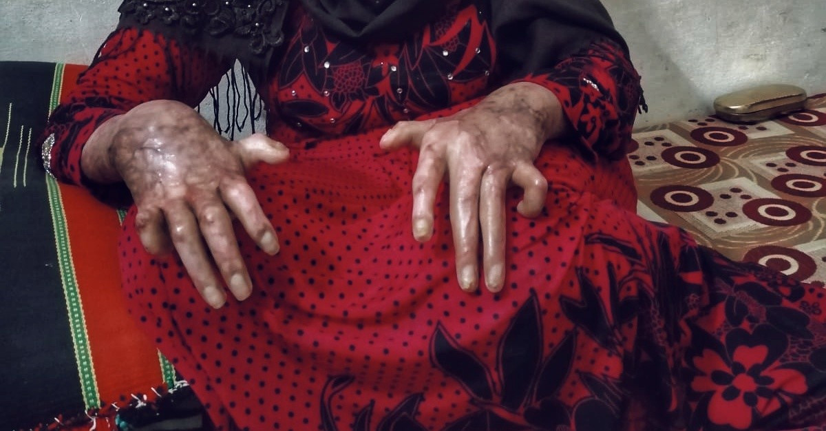 A woman had burns due to shelling
