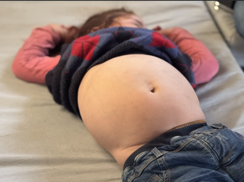Mohammed and His Siblings Suffer from Liver Enlargement