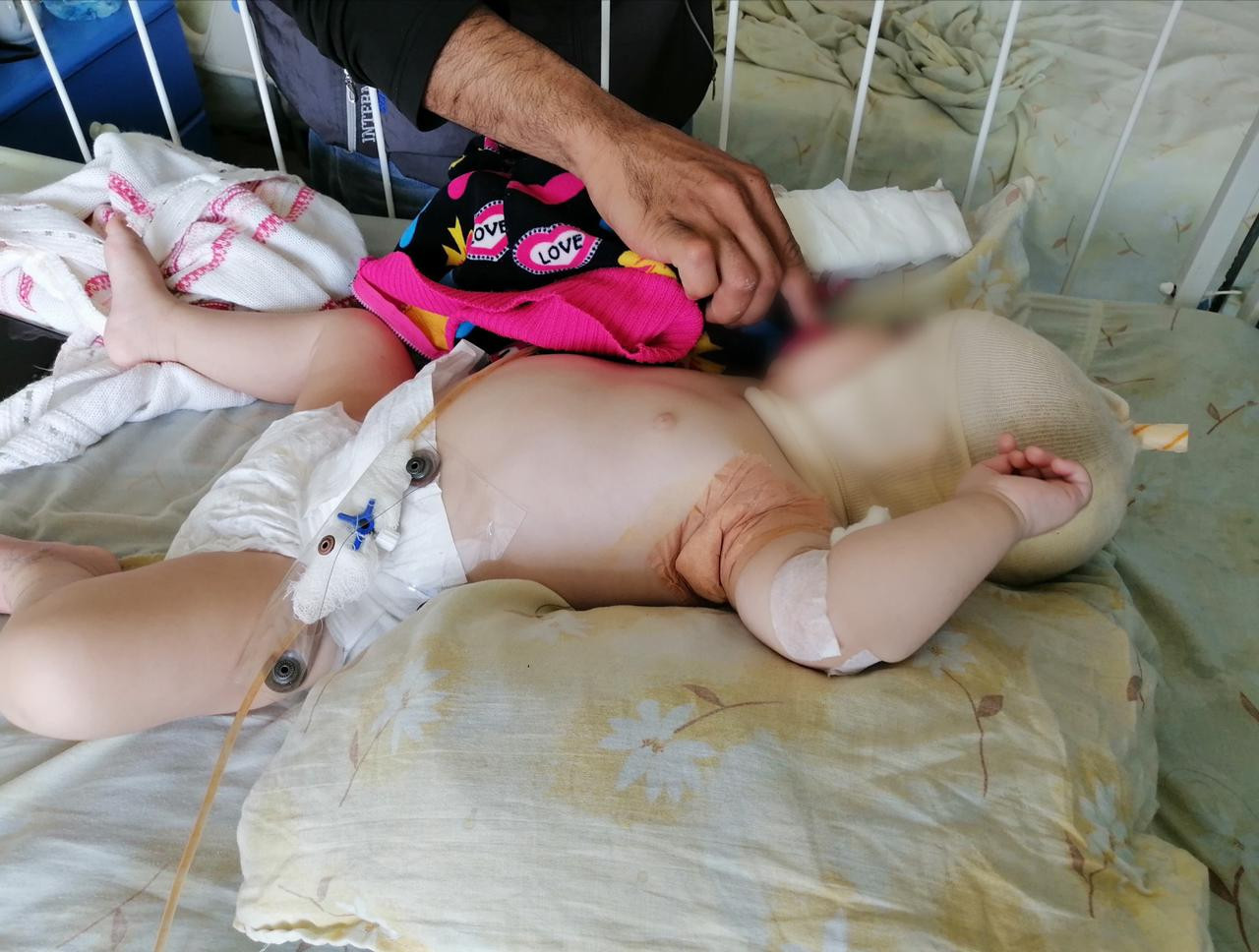 A newborn is with burns needs urgent surgery