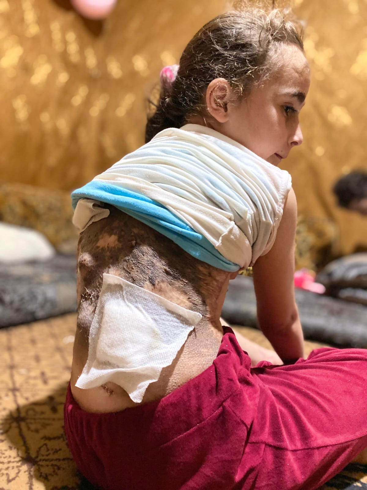Hala suffers from a rare skin disease