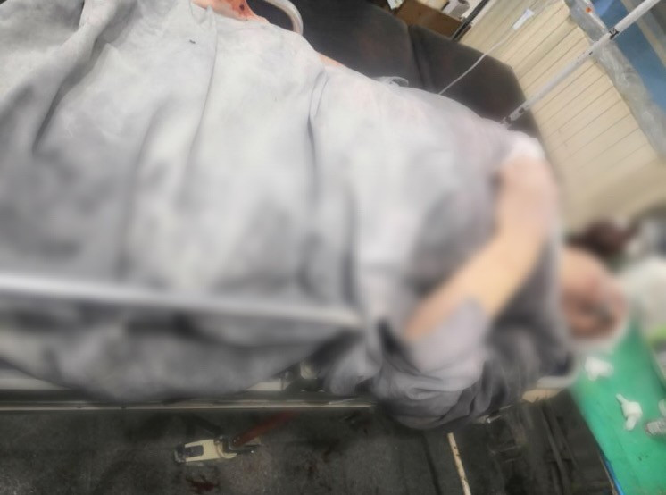 مريض تعرض لإصابات عدة إثر القصف الغاشم