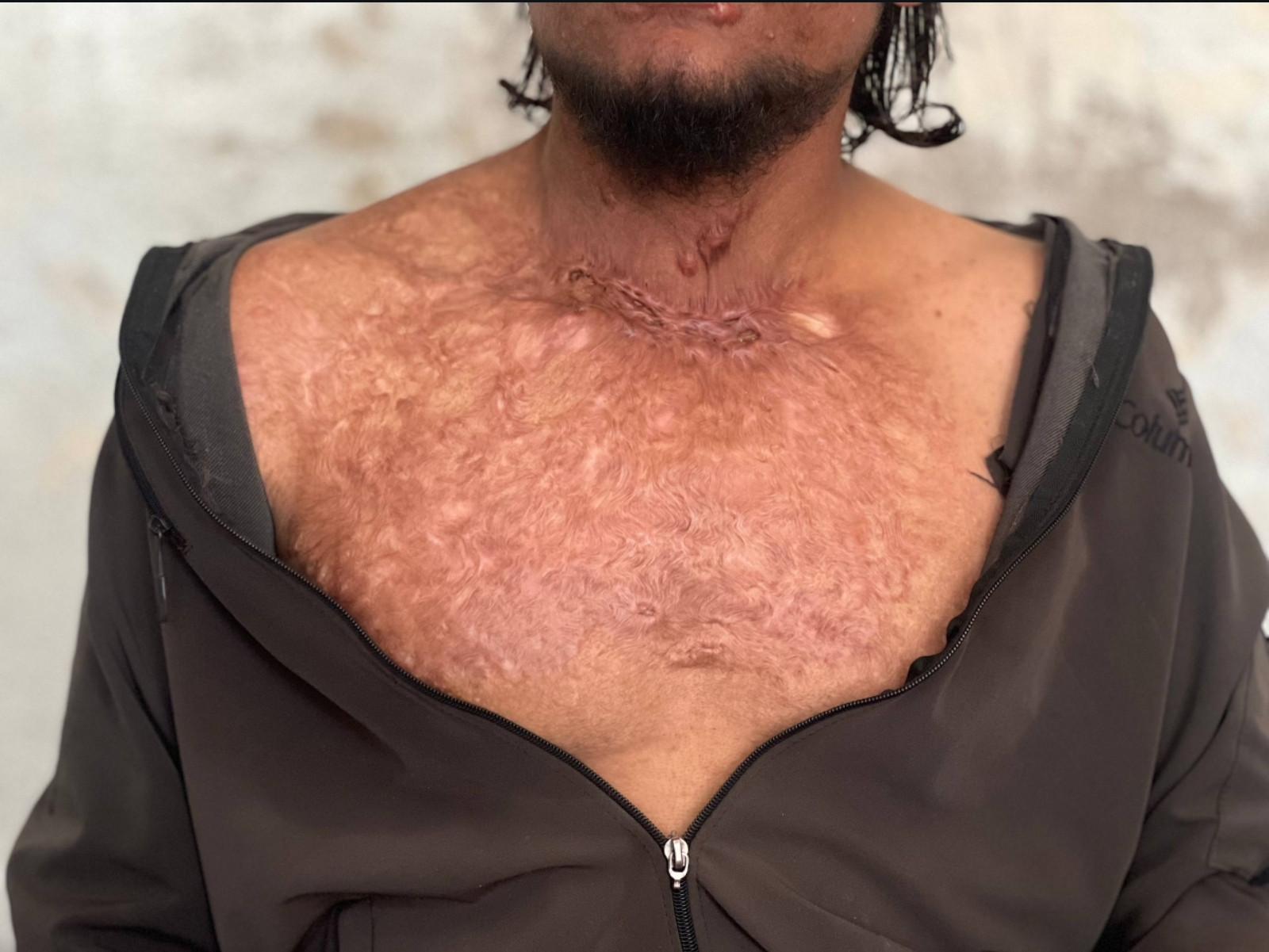 حروق مؤلمة وحياة صعبة