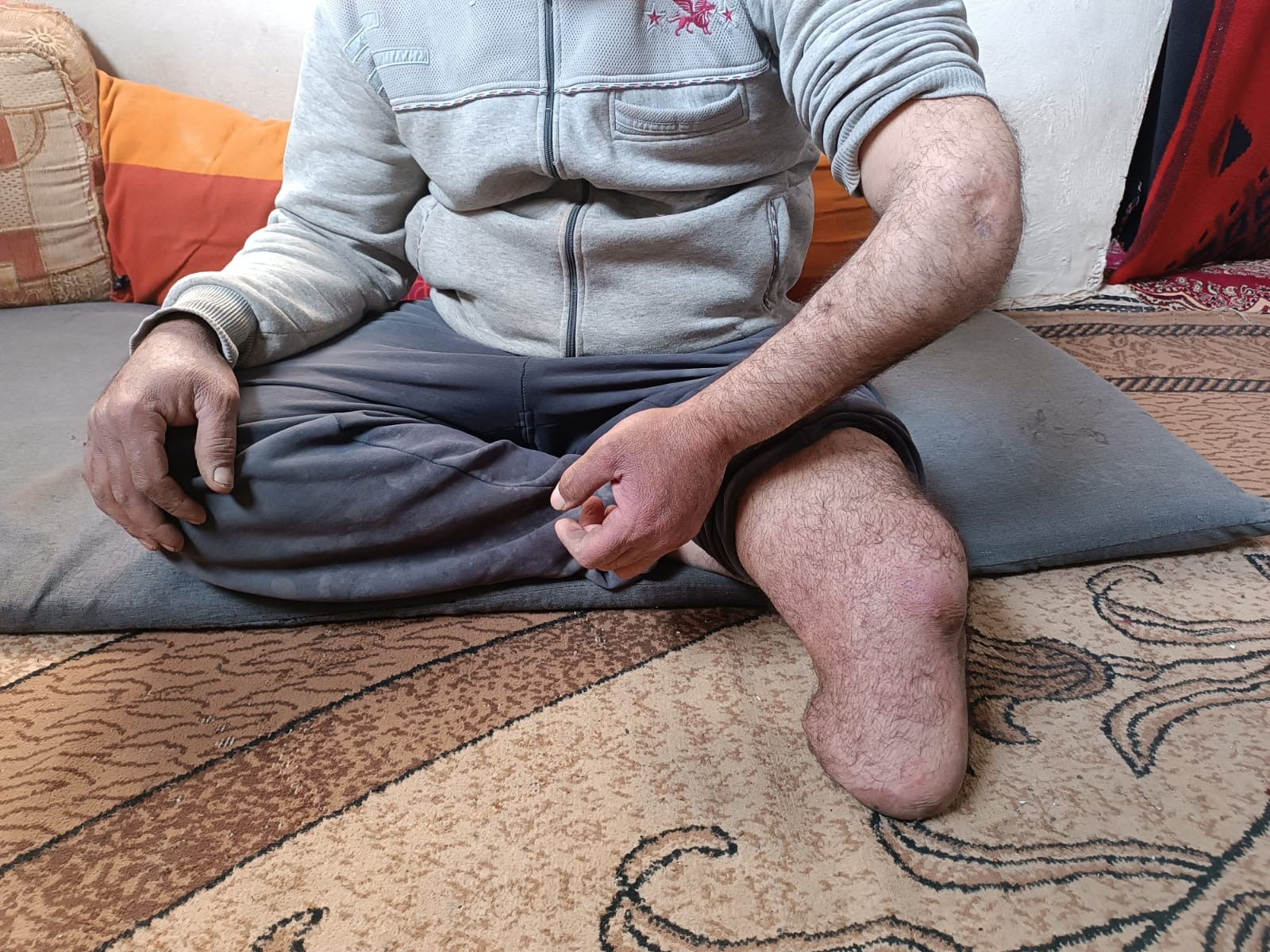 بتره لم يعجزه لكن حريق منزله أكل ما كان بقي له