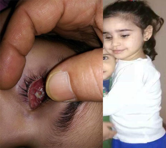 A child in need for implantation of an artificial eye