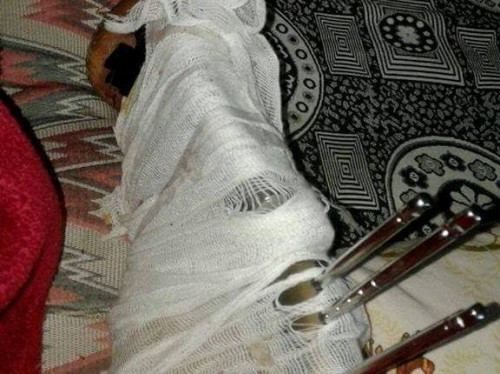 A cancer patient in Turkey