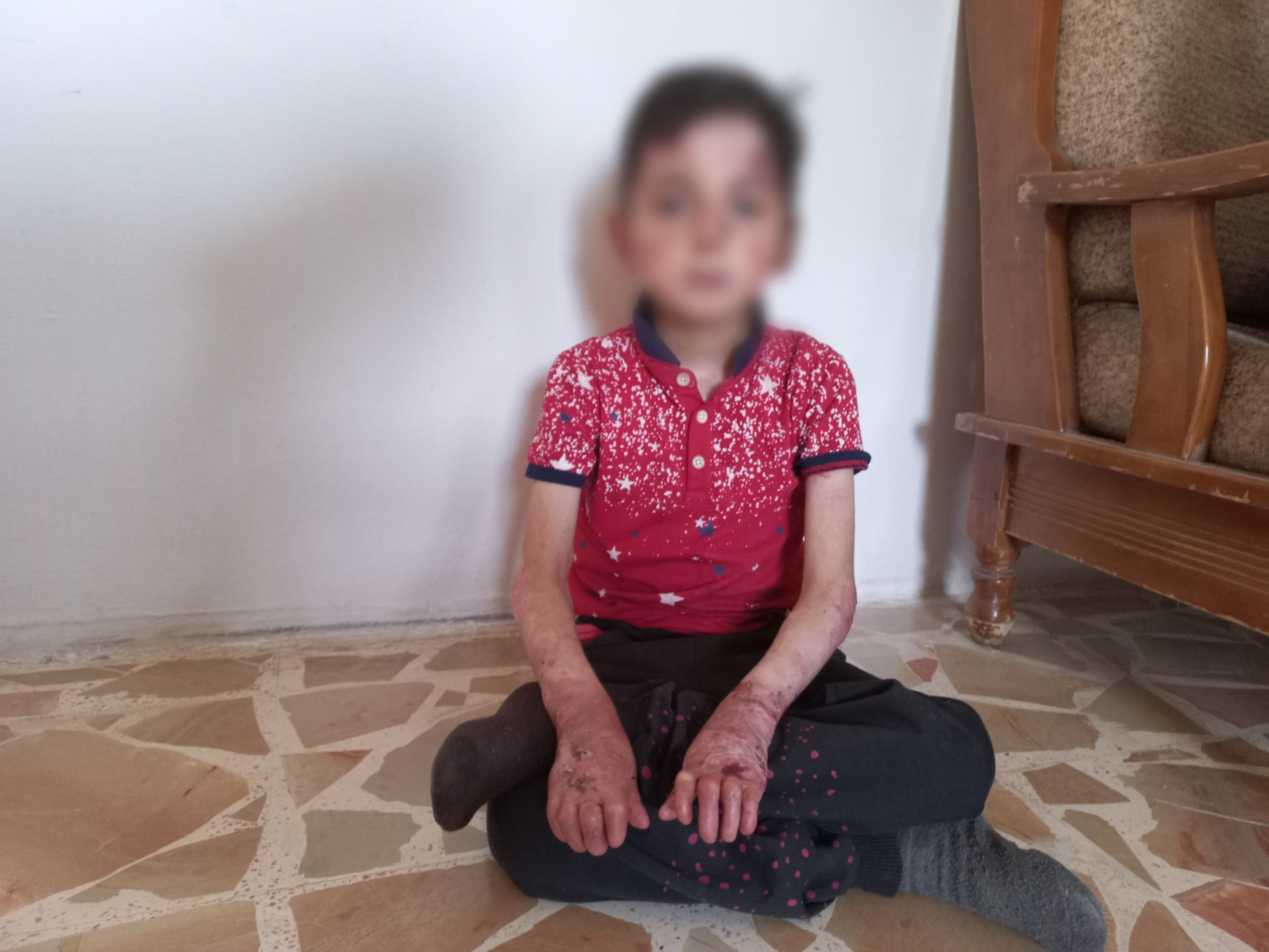 A child suffering from congenital pemphigus