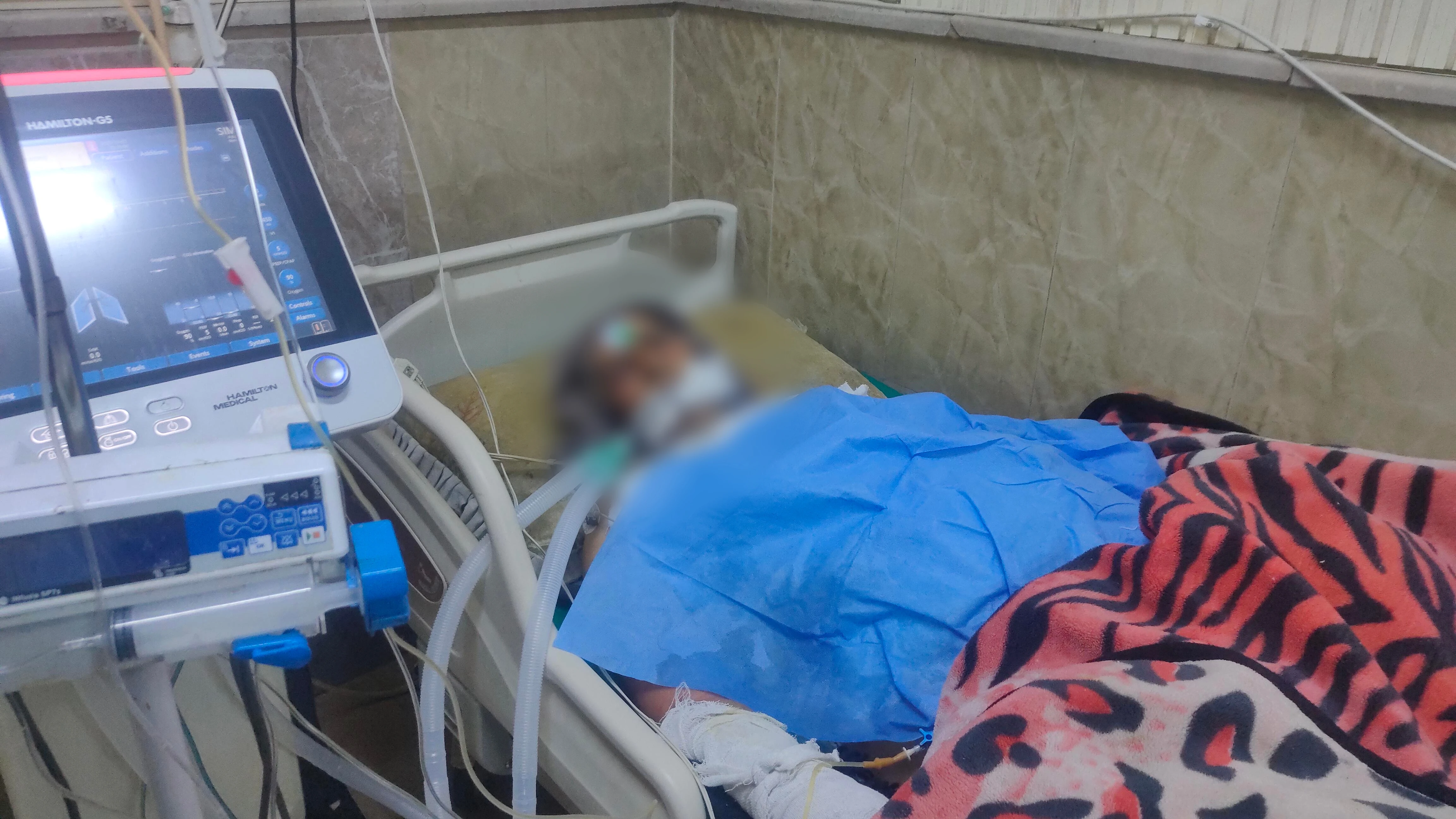 نار أثقلت جسد سارة وأرهقت أسرتها..