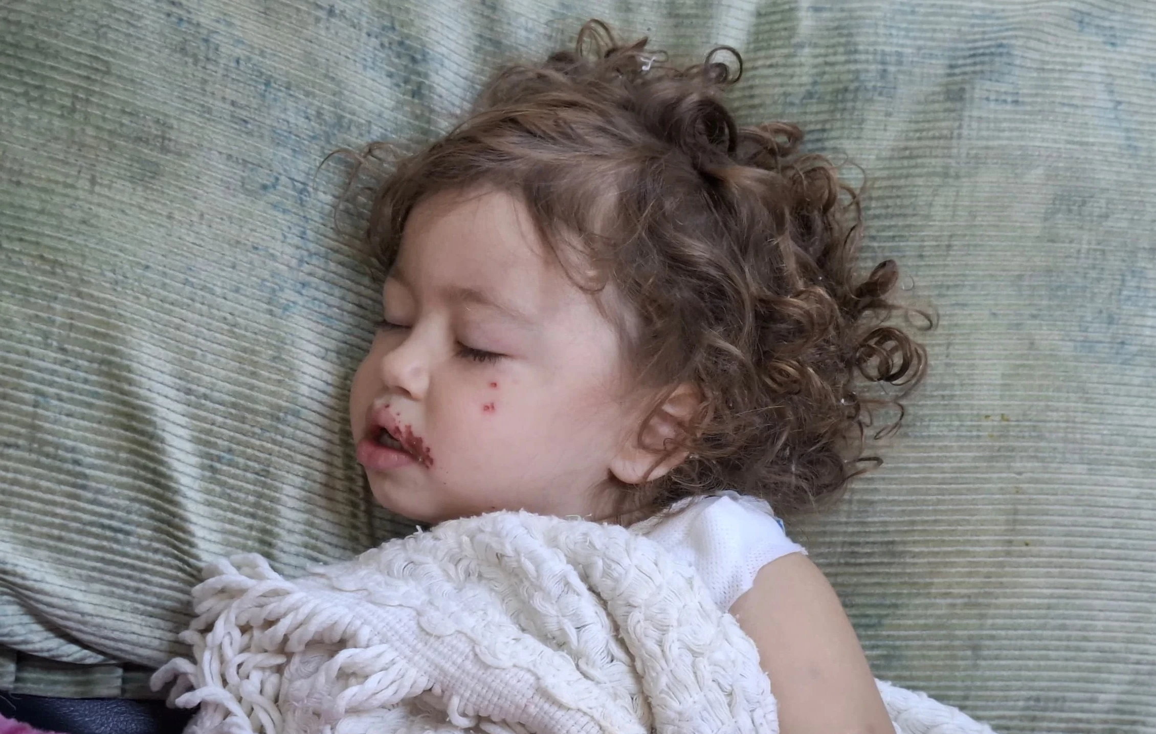 لانا...طفولة احترقت في لحظة